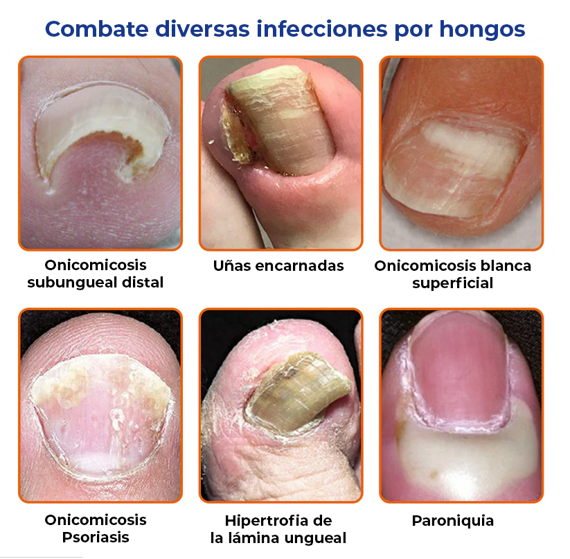 [2X1] Joy Pretty® -Elimina los hongos de las uñas