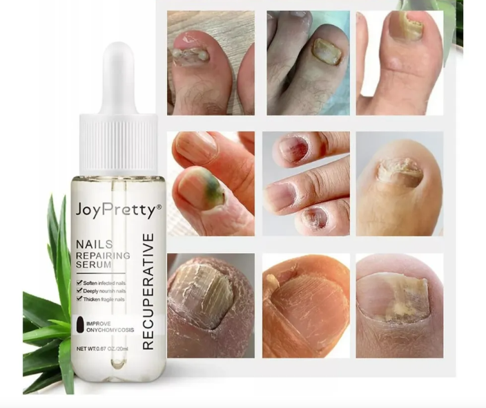 [2X1] Joy Pretty® -Elimina los hongos de las uñas